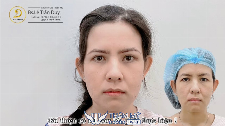 Địa chỉ nâng cung chân mày tại TPHCM uy tín - Thẩm mỹ Galaxy