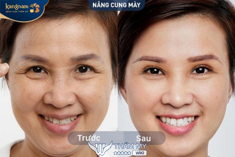 Địa chỉ nâng cung chân mày đẹp tại TPHCM - Bệnh viện thẩm mỹ Kangnam