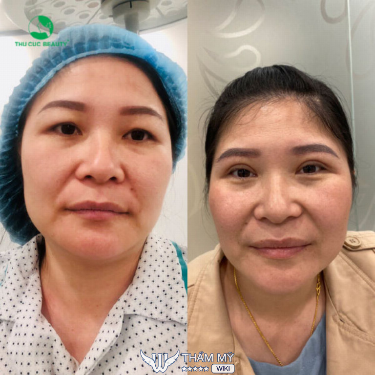 Nâng cung chân mày ở đâu tốt tại TPHCM? TMV Thu Cúc