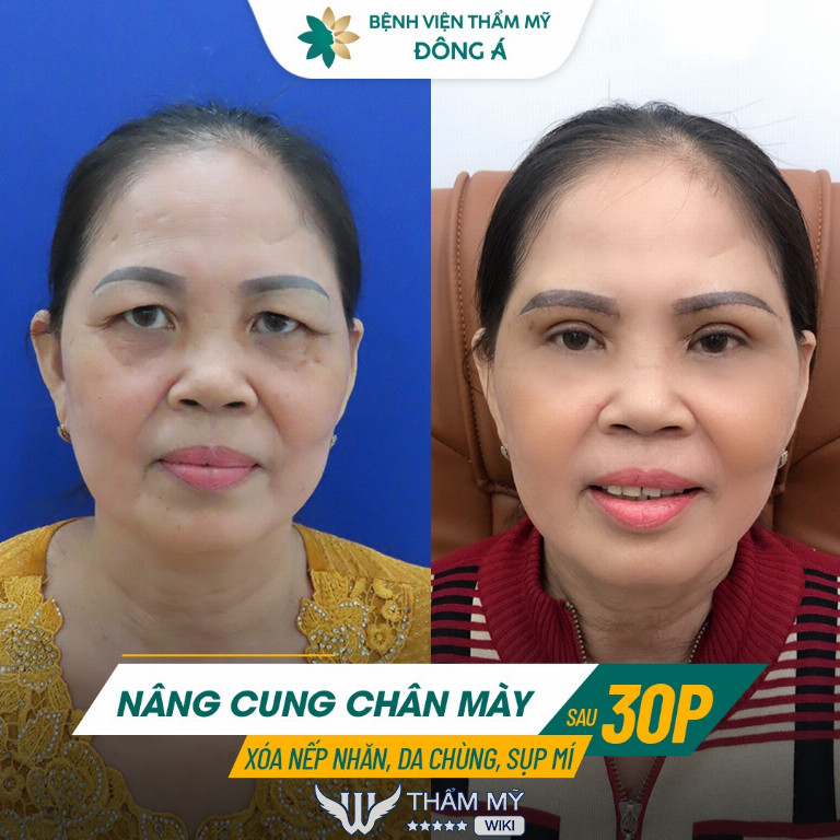 Nâng cung chân mày ở đâu tốt tại TPHCM? Bệnh viện thẩm mỹ Đông Á