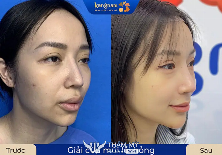 Địa chỉ sửa mũi hỏng tại TPHCM uy tín - Bệnh viện thẩm mỹ Kangnam