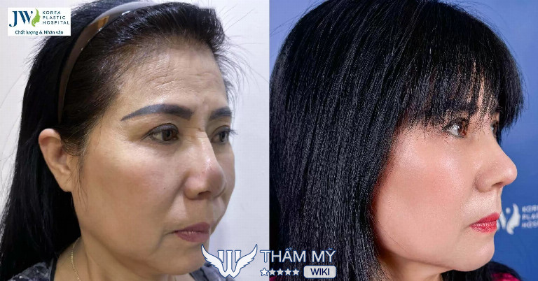 Sửa mũi hỏng ở đâu tốt tại TPHCM? Bệnh viện thẩm mỹ JW Hàn Quốc