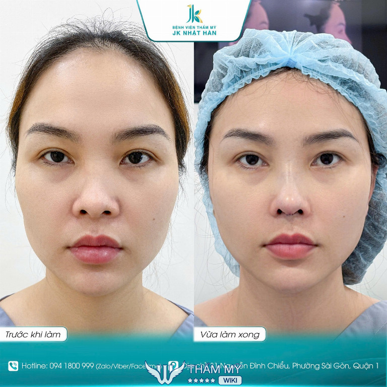 Địa chỉ thu gọn cánh mũi đẹp ở TPHCM - Viện thẩm mỹ JK Nhật Hàn