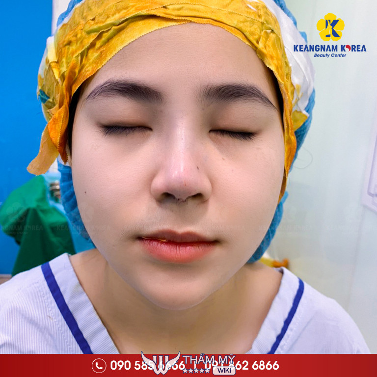 Địa chỉ thu gọn cánh mũi uy tín tại TPHCM - Viện sắc đẹp Keangnam Korea