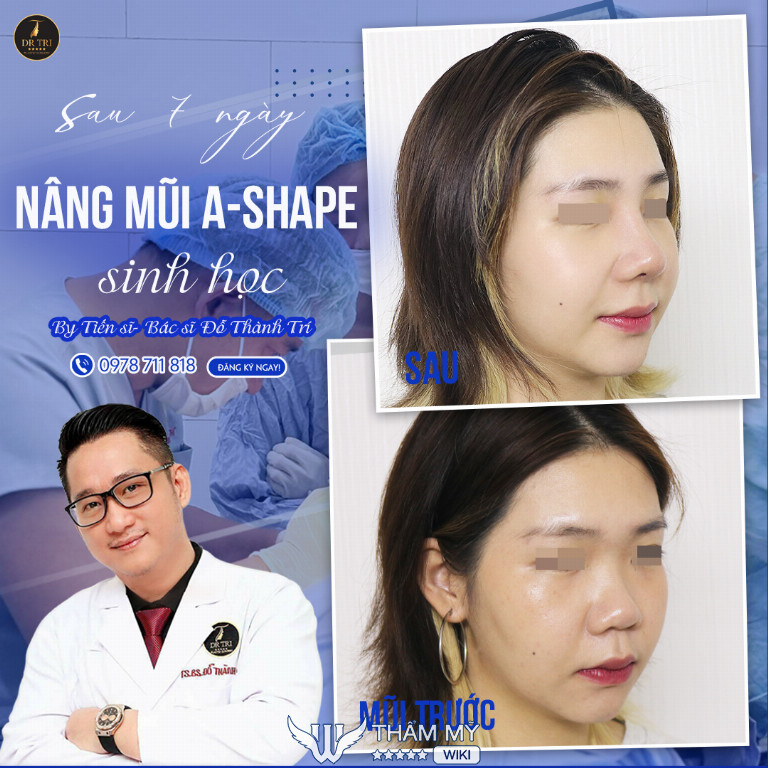 Review tiến sĩ bác sĩ Đỗ Thành Trí phẫu thuật thẩm mỹ có tốt không