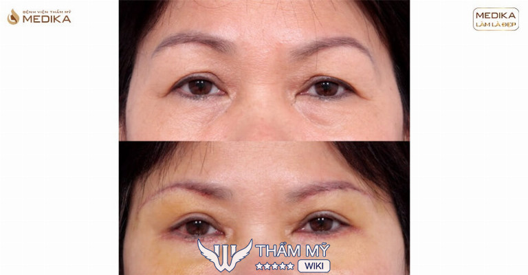 Treo cung chân mày ở đâu đẹp tại TPHCM? Medika