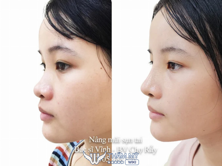 nâng mũi tại Tiến sĩ Bác sĩ Lê Hoàng Vĩnh 