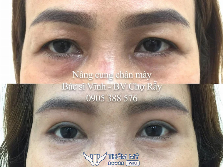 Nâng cung chân mày tại bác sĩ Lê Hoàng Vĩnh bệnh viện Chợ Rẫy