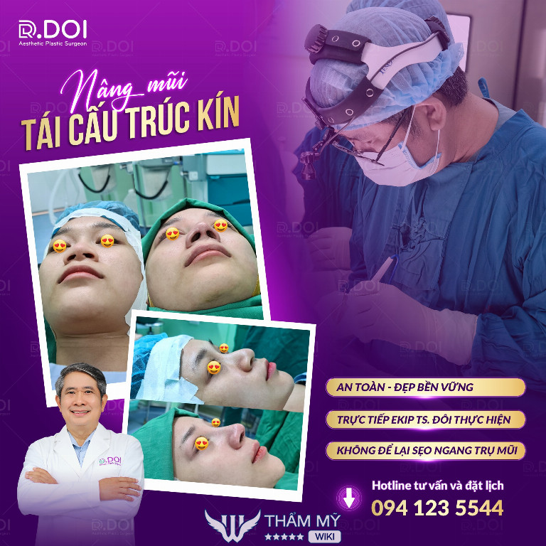 Tiến sĩ bác sĩ Phạm Văn Đôi nâng mũi cấu trúc kín