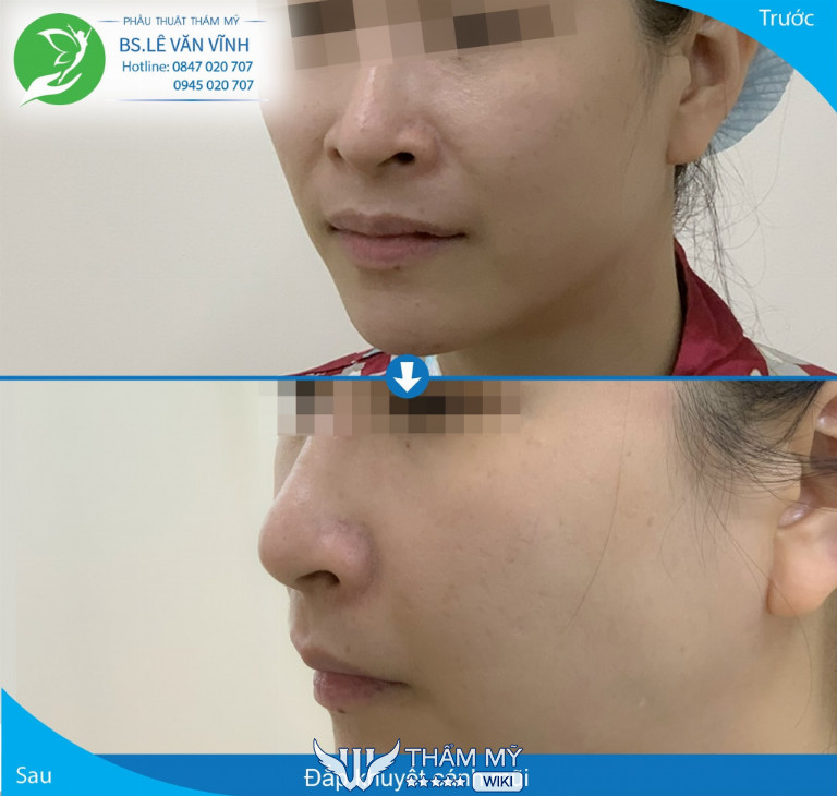 Địa chỉ đắp khuyết cánh mũi ở TPHCM