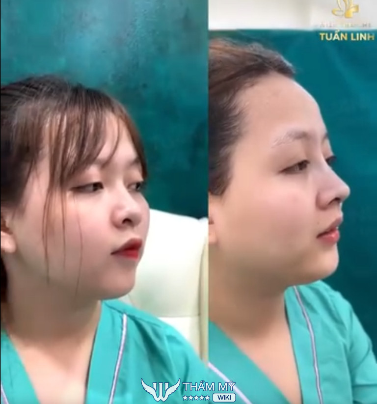 Địa chỉ đắp khuyết cánh mũi tại TPHCM