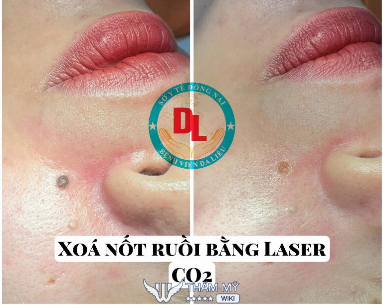 Địa chỉ tẩy nốt ruồi ở Biên Hòa