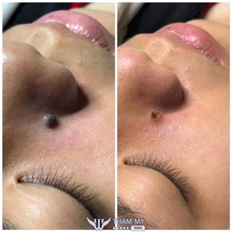 Địa chỉ tẩy nốt ruồi giá rẻ ở Biên Hòa