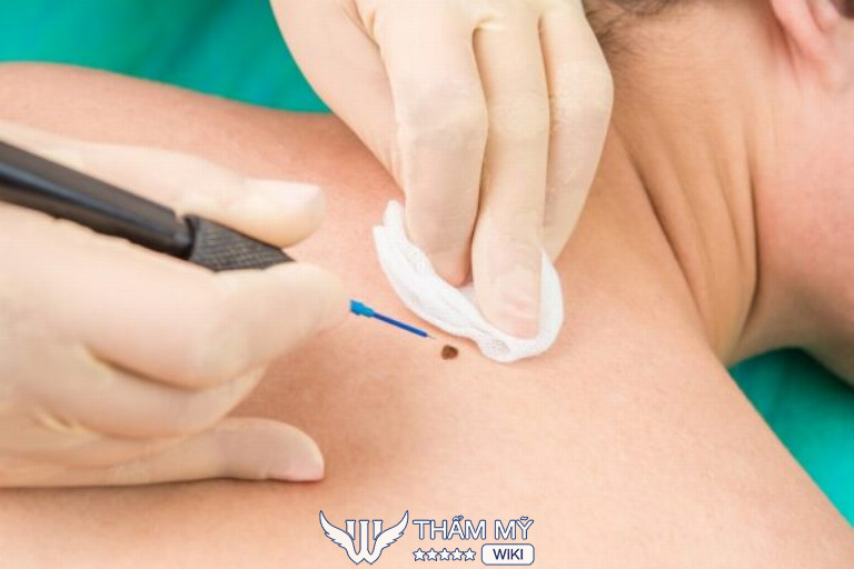 Địa chỉ tẩy nốt ruồi ở Biên Hòa hiệu quả