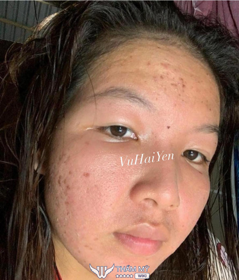 các địa chỉ tẩy nốt ruồi ở Biên Hòa