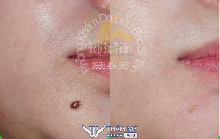 Địa chỉ đốt mụn ruồi ở Thái Bình - Phòng khám Da liễu Bác sĩ Tân