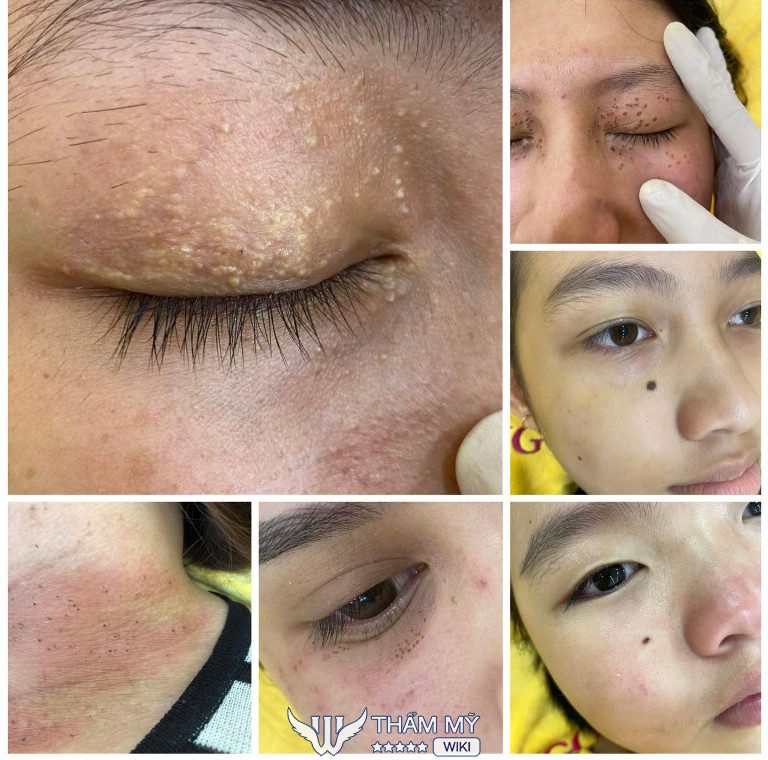 Địa chỉ tẩy nốt ruồi ở Thái Bình - Thẩm mỹ viện Ngọc Hường