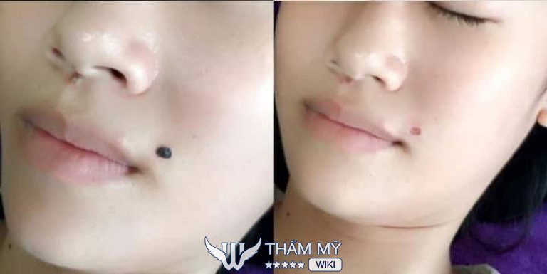 Địa chỉ tẩy nốt ruồi ở Thái Bình - Salon Huyền Trang