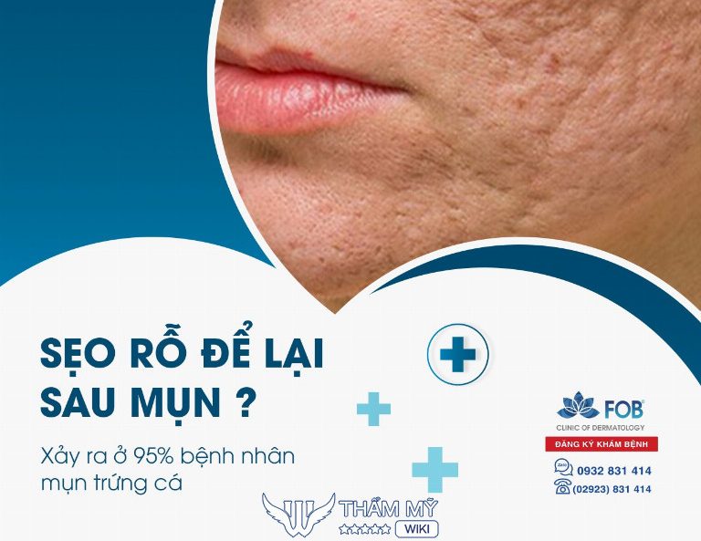 Phòng Khám Da Liễu FOB trị sẹo rỗ ở Cần Thơ 
