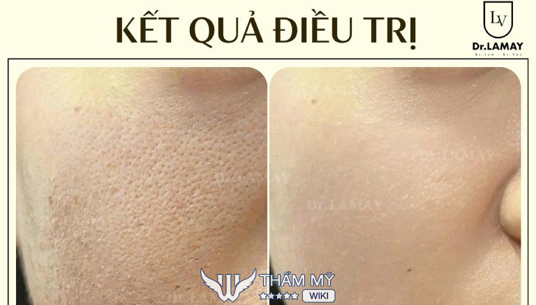Phòng Khám Chuyên Khoa Da Liễu Dr.Lamay trị sẹo rỗ ở Cần Thơ 