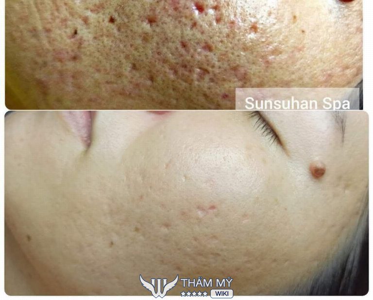 Sunsuhan Spa trị sẹo rỗ tại Cần Thơ 