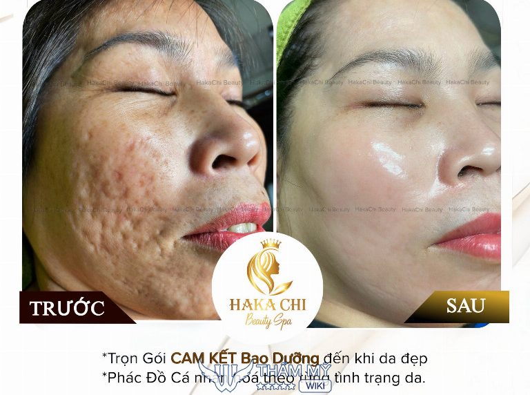HakaChi Spa trị sẹo rỗ Cần Thơ 