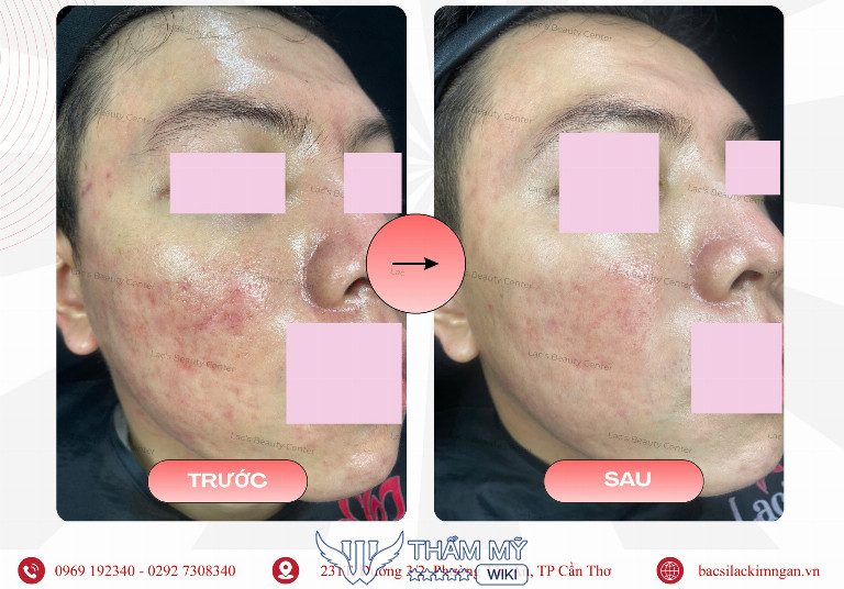 Phòng Khám Da Liễu Lạc’s Beauty Center trị sẹo rỗ ở Cần Thơ