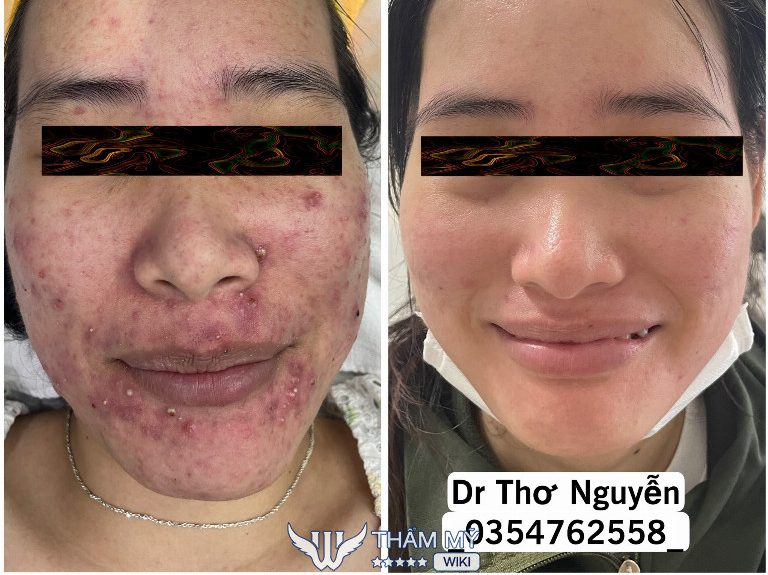 spa trị mụn hiệu quả ở Củ Chi Dr Thơ Nguyễn 