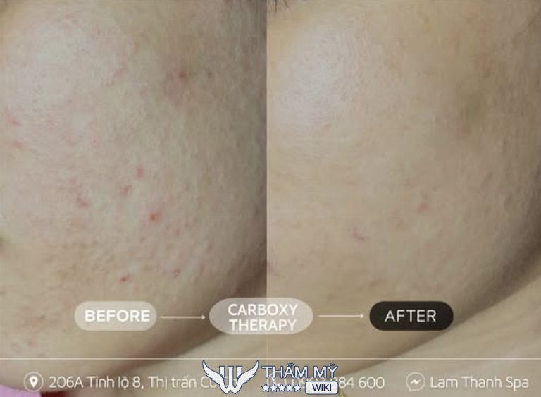 Lam Thanh spa trị mụn ở Củ Chi