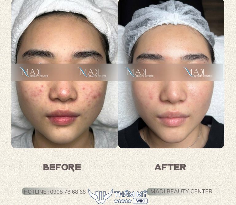 Madi Beauty Center spa trị mụn ở Củ Chi