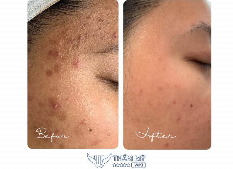 Chee Spa trị mụn Củ Chi