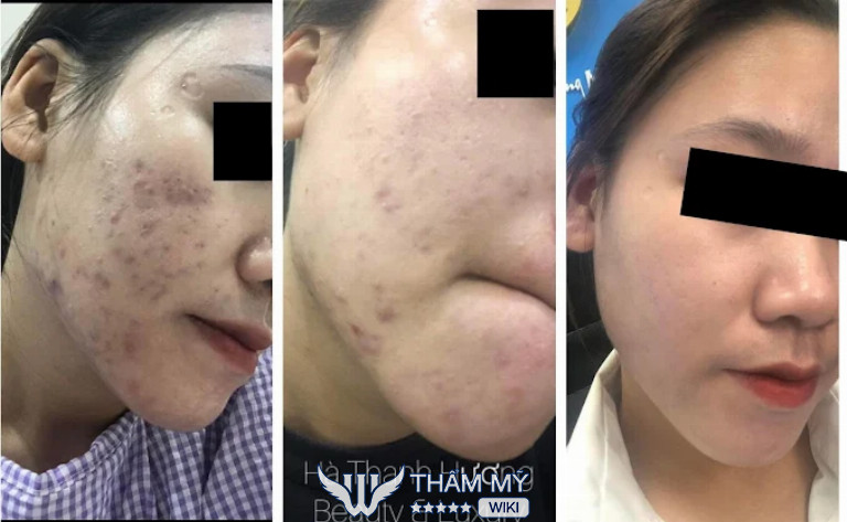 Hà Thanh Hương Beauty & Luxury Spa trị mụn tại Gia Lâm Hà Nội