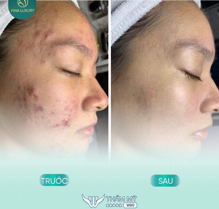 Pina Spa trị mụn hiệu quả ở Gia Lâm Hà Nội