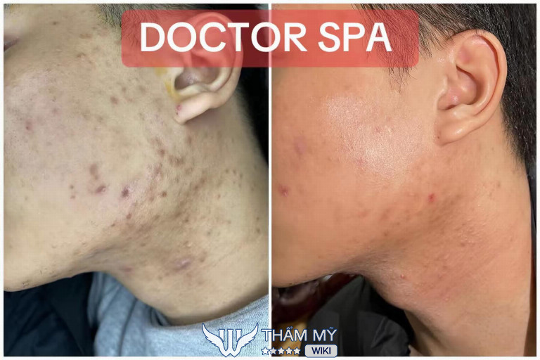 Doctor Spa trị mụn tại Gia Lâm Hà Nội