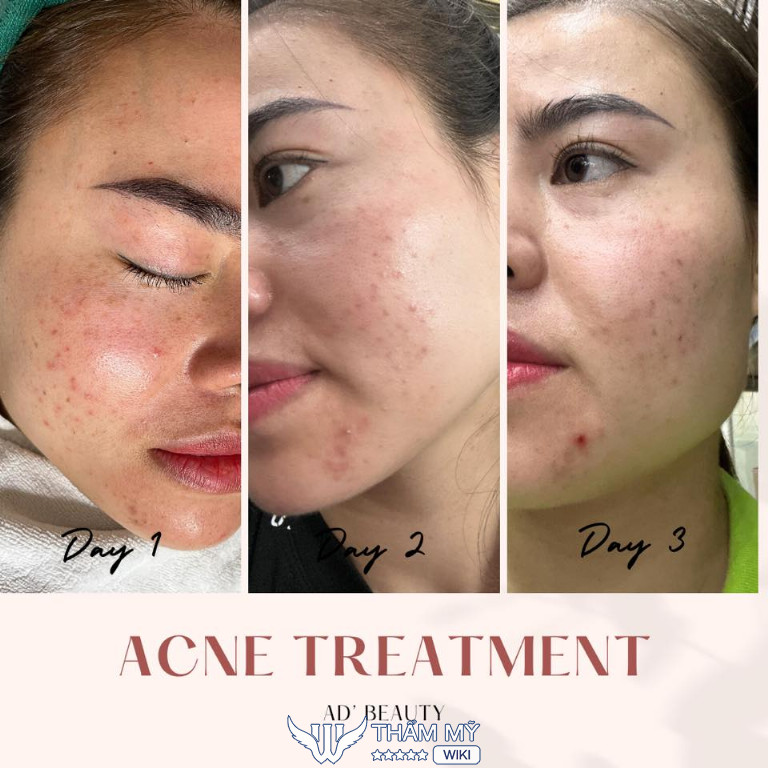 các địa chỉ Spa trị mụn ở Gia Lâm Hà Nội