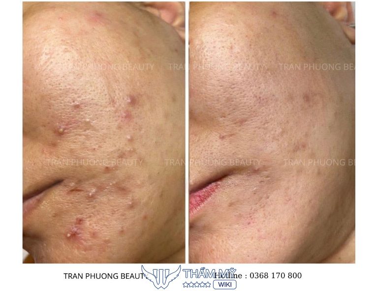 Trần Phương Beauty & Spa trị mụn ở Gia Lâm Hà Nội