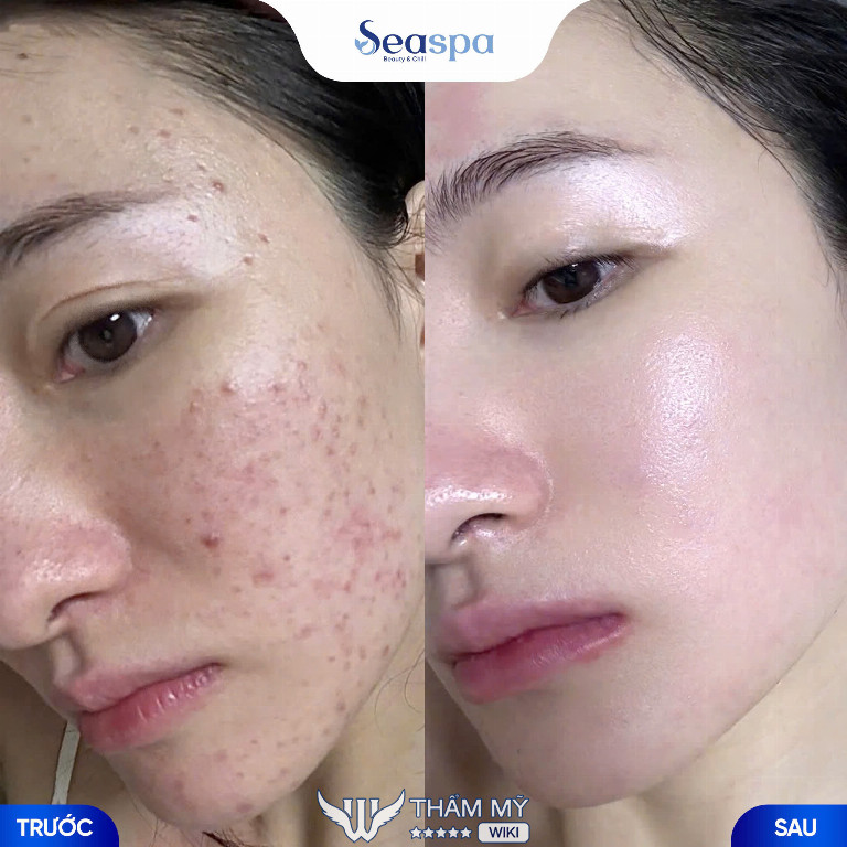Sea Spa trị mụn ở Vinh