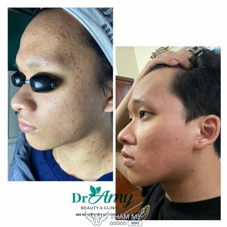 Dr Amy Beauty & Clinic trị mụn ở Vinh