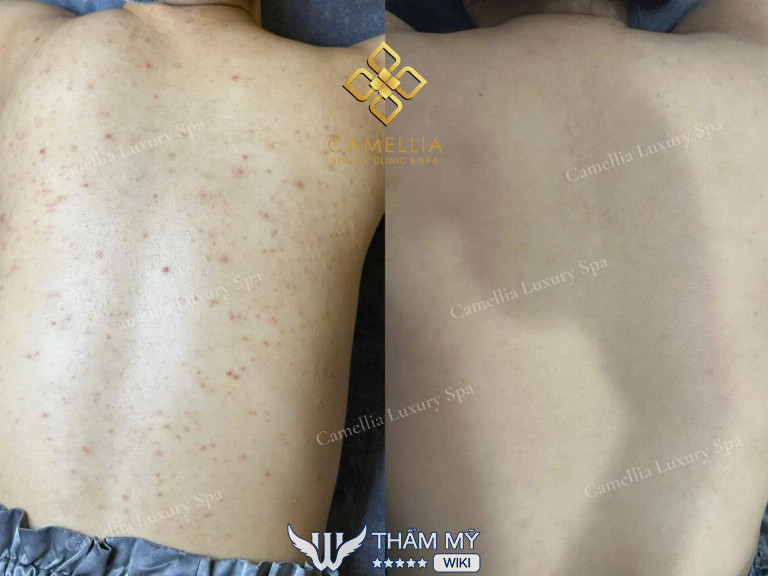 Camellia Spa trị mụn ở Vinh