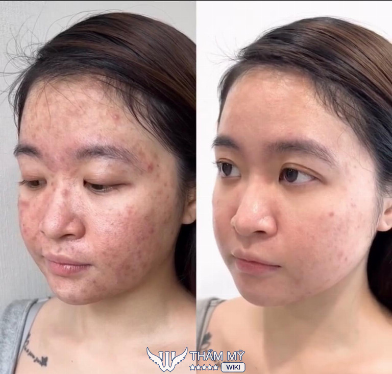 Amia Beauty Center Spa trị mụn ở Vinh