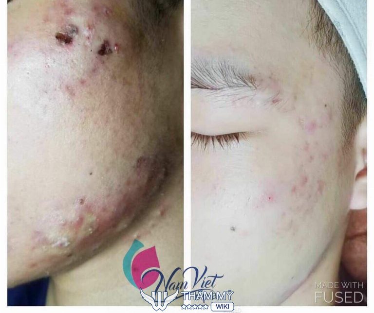 Nam Việt Spa trị mụn ở Vinh