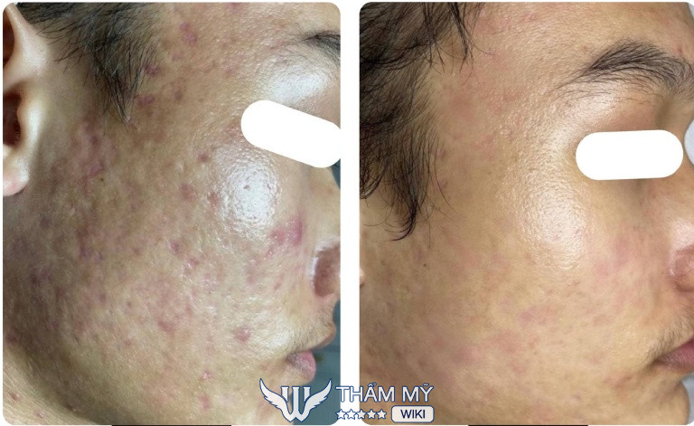 Her Skincare Spa trị mụn ở Vinh