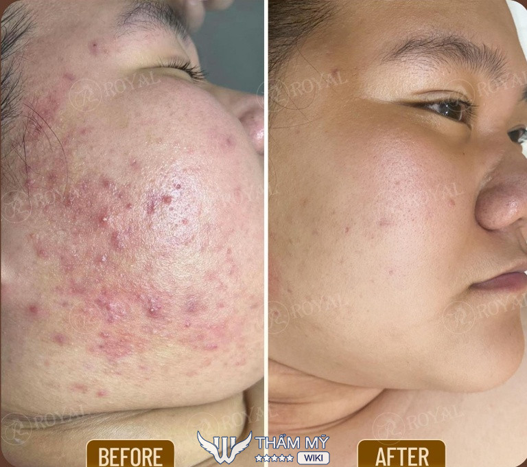 Thẩm mỹ Quốc tế Royal trị mụn ở Vinh