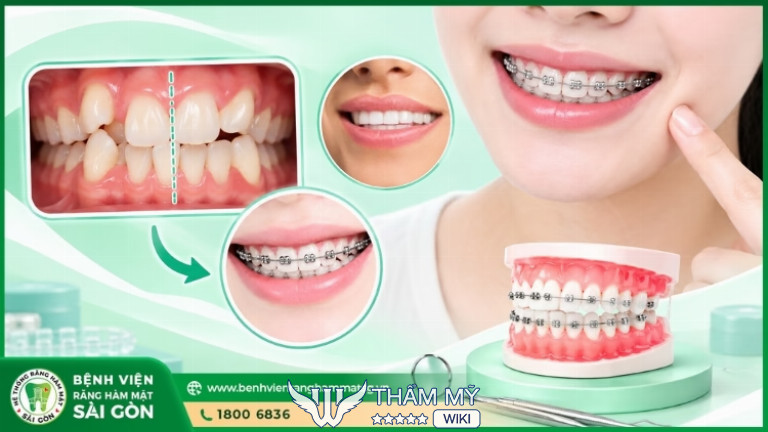 Niềng răng tại Bệnh Viện Răng Hàm Mặt Sài Gòn