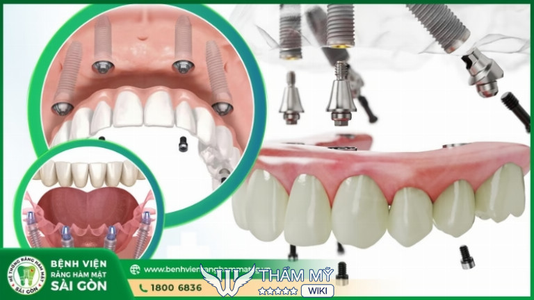 Cấy ghép Implant tại Bệnh Viện Răng Hàm Mặt Sài Gòn
