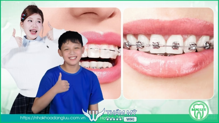 niềng răng tại Nha Khoa Đăng Lưu